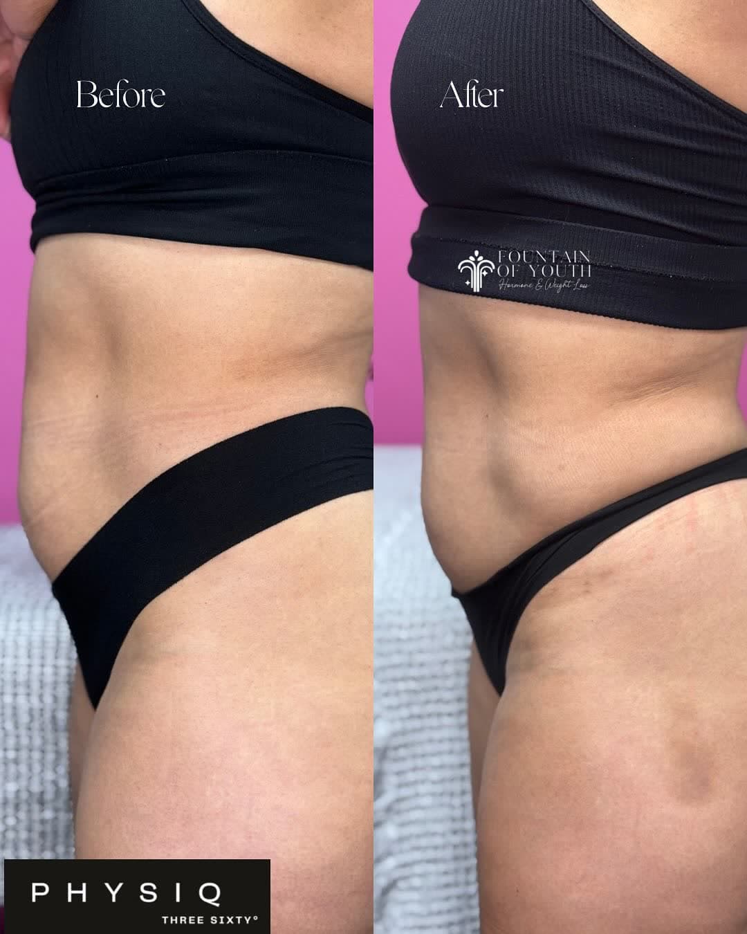 Real PHYSIQ 360 before and after results, side view, from a Fountain of Youth LC patient